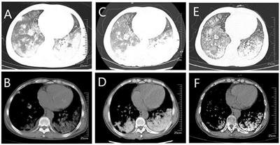 Pulmonary alveolar microlithiasis combined with gastric mucosal calcification: a case report